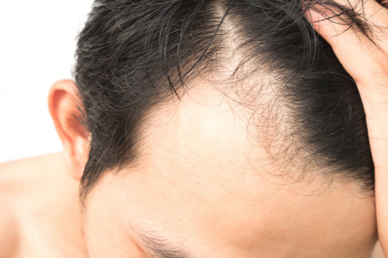 Hair Loss in men