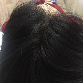 Result After Medihair Treatment for Hair Loss