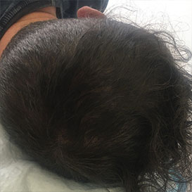 After Scalp Micropigmentation Hair Transplantation