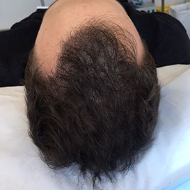 After Medihair FUE Hair Transplant Treatment