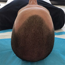 After Medihair FUT Hair Transplant for Hair Loss