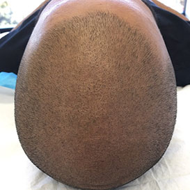 Results After Medihair Hair Loss Treatment