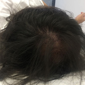 After Medihair SMP Hair Transplant