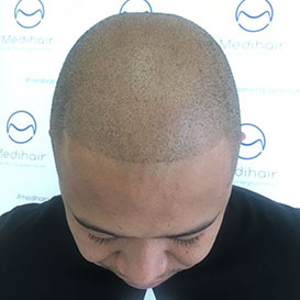 After SMP Hair Transplantation at Medihair