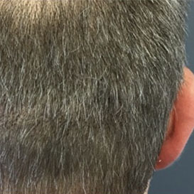 After SMP Natural Hair Transplantation at Medihair