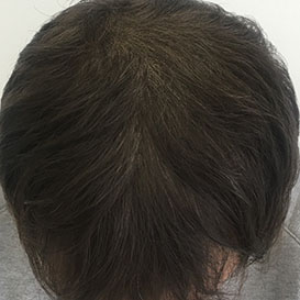 After PRP Hair Loss Treatment at Medihair in Melbourne