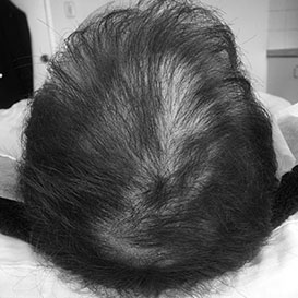 Before Medihair FUE Hair Transplant Treatment