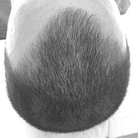 Before Medihair FUT Hair Transplant for Hair Loss