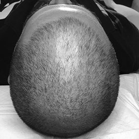 Before Medihair Hair Loss Treatment