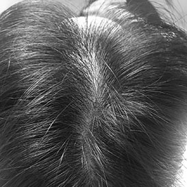 Before Medihair Treatment for Hair Loss
