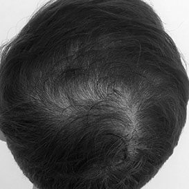 Before Medihair Hair Transplant