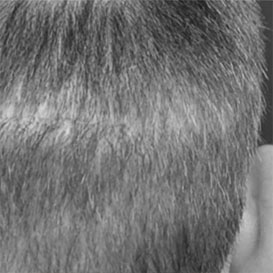 Before Medihair Hair Transplantation