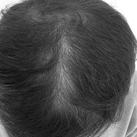 Before PRP Hair Loss Treatment