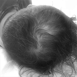 Before Scalp Micropigmentation Hair Transplantation