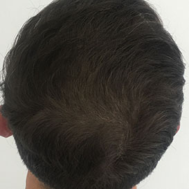 Medihair Hair Transplant After Result