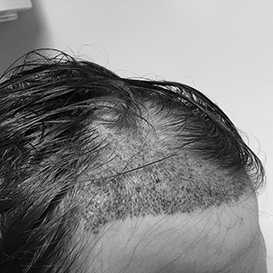 Before Hair Transplant