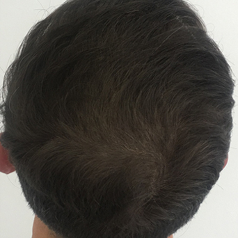 SMP Hair Transplant Before and After at Medihair