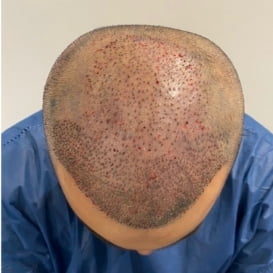 After Hair Transplant