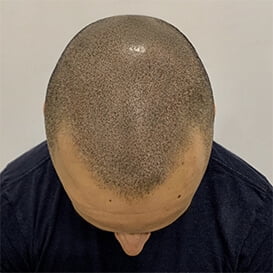 After Hair Transplant