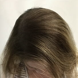 After Hair Transplant