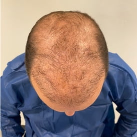After Hair Transplant