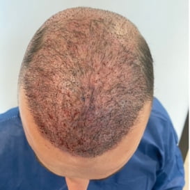After Hair Transplant