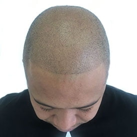 After Hair Transplant