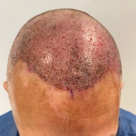 After Hair Transplant