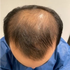 Before Hair Transplant