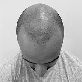 Before Hair Transplant