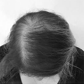 Before Hair Transplant