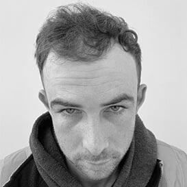 Before Hair Transplant