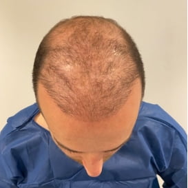 Before Hair Transplant