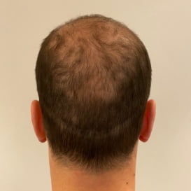Before Hair Transplant