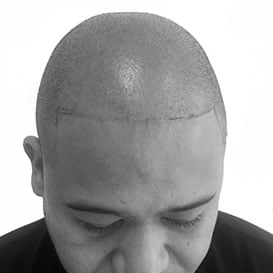 After Hair Transplant