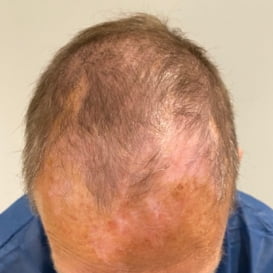 Hair Transplant Before