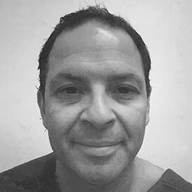 After Hair Transplant