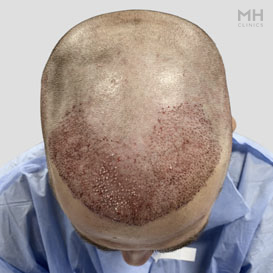 After Hair Transplant