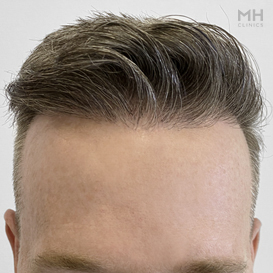 After Hair Transplant