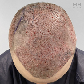 After Hair Transplant