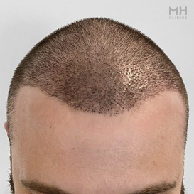 After Hair Transplant