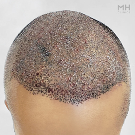 After Hair Transplant