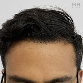 After Hair Transplant