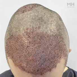 After Hair Transplant