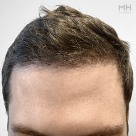 After Hair Transplant