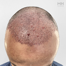 After Hair Transplant