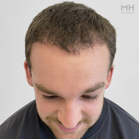 After Hair Transplant