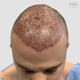 After Hair Transplant