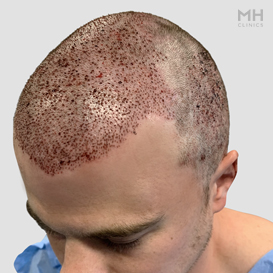 After Hair Transplant