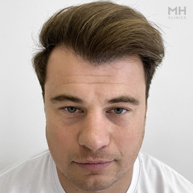 After Hair Transplant